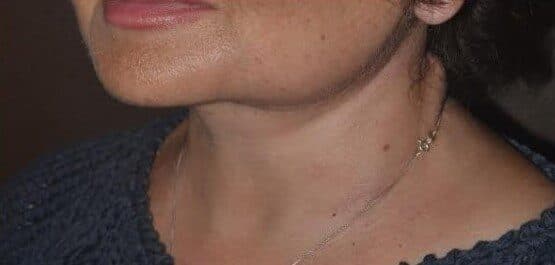 neck lift after