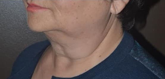 neck lift before