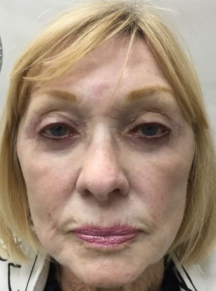 laser trl after