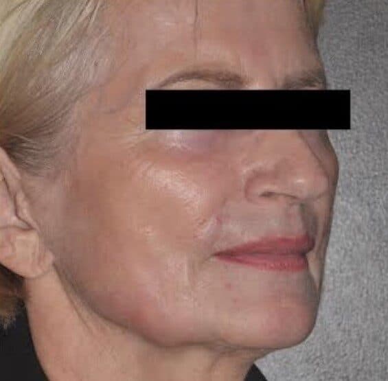 laser trl after