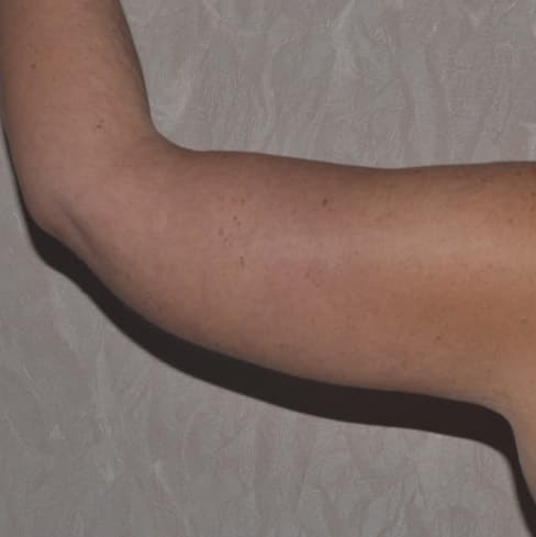 arm lift - after