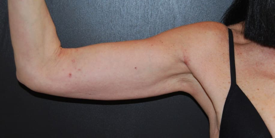 arm lift - after