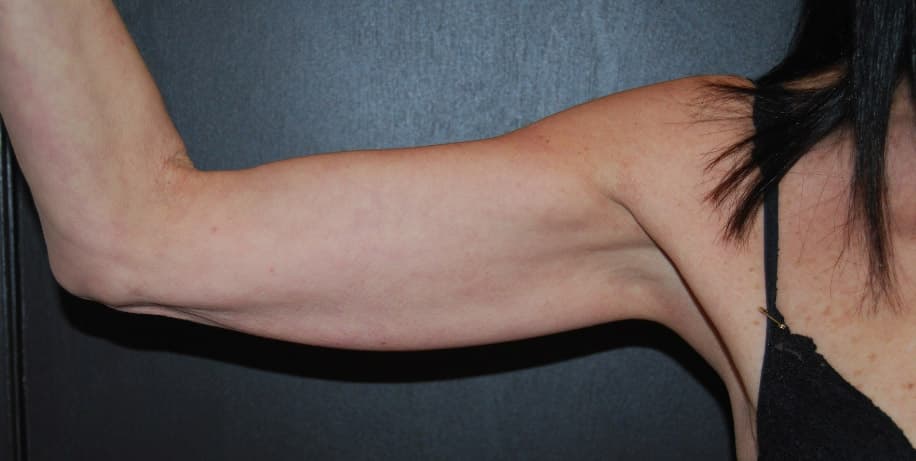 arm lift - before