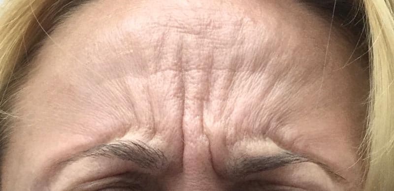 botox before