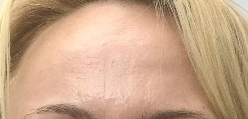 botox after