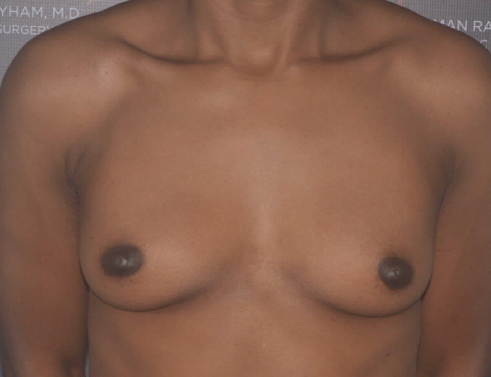 breast augmentation before
