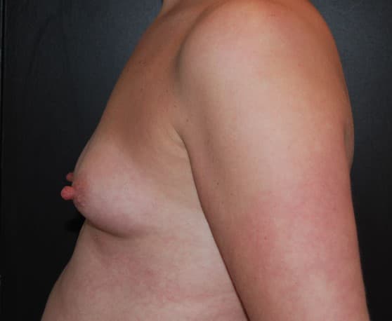 breast augmentation before