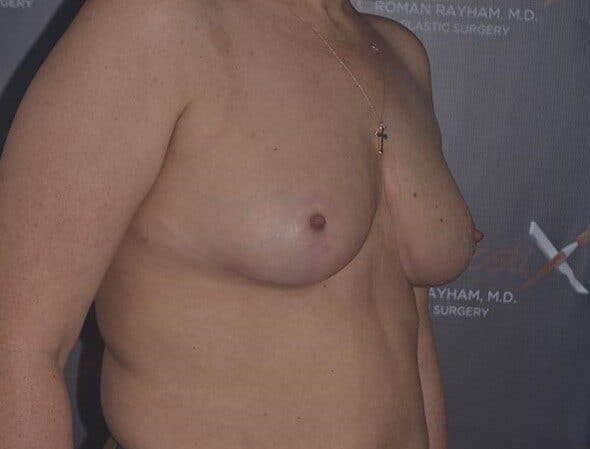 breast reduction after