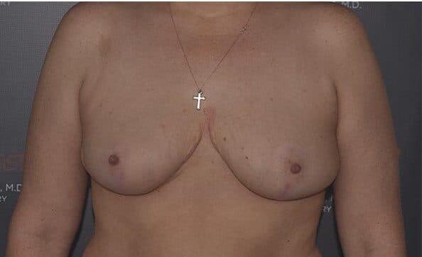 breast reduction after