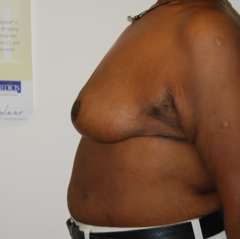 breast reduction after