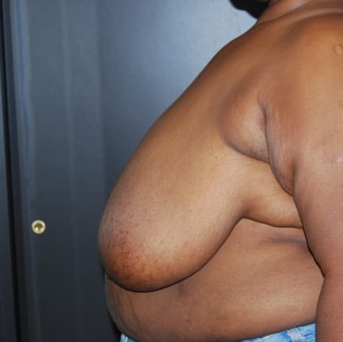 breast reduction before