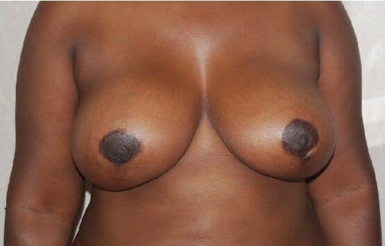 breast reduction after