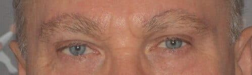 brow lift after
