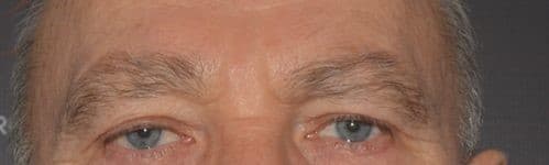 brow lift before