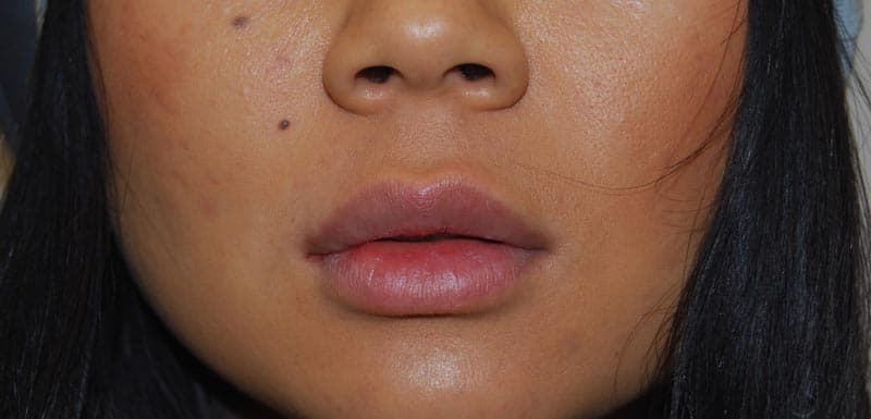 buccal fat removal after