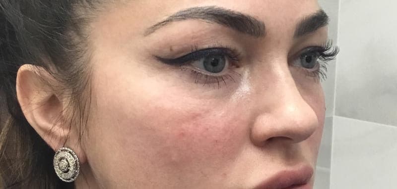 cheek filler after