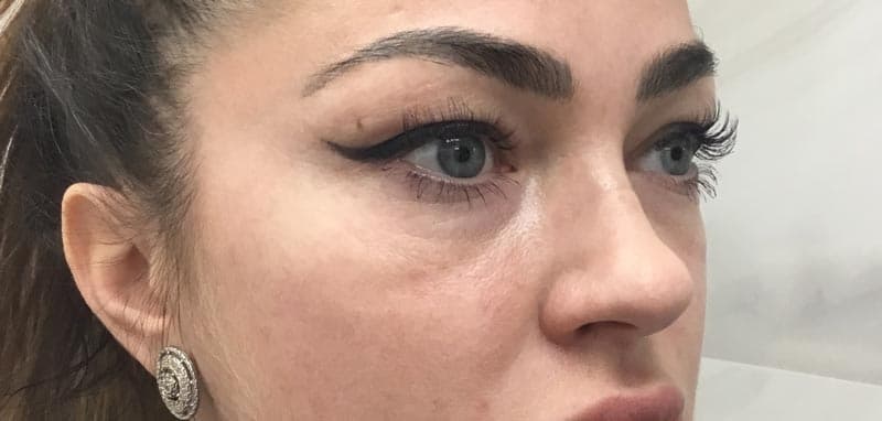 cheek filler before
