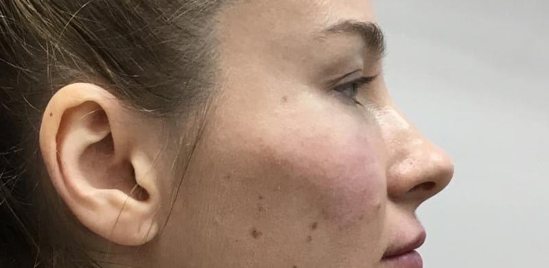 cheek filler after