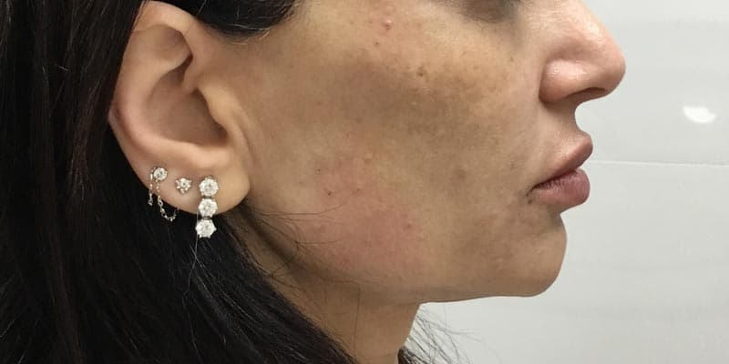 cheek filler after