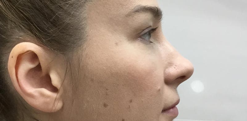 cheek filler before