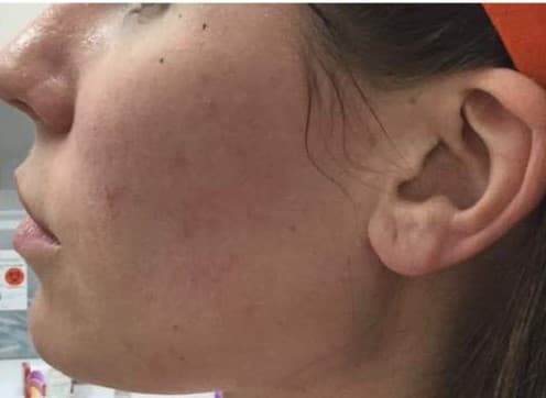 cheek filler after
