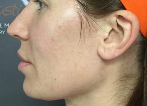 cheek filler before