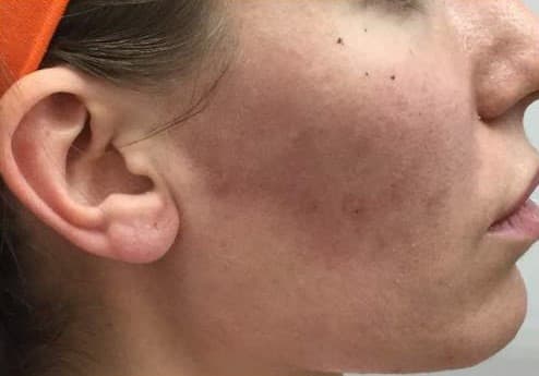 cheek filler after