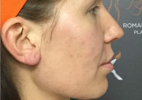 cheek filler before