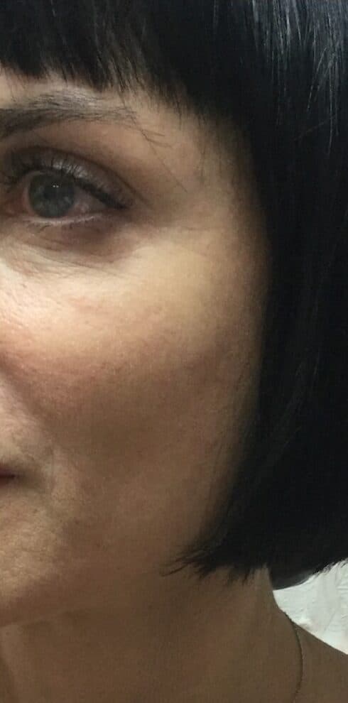 cheek filler after