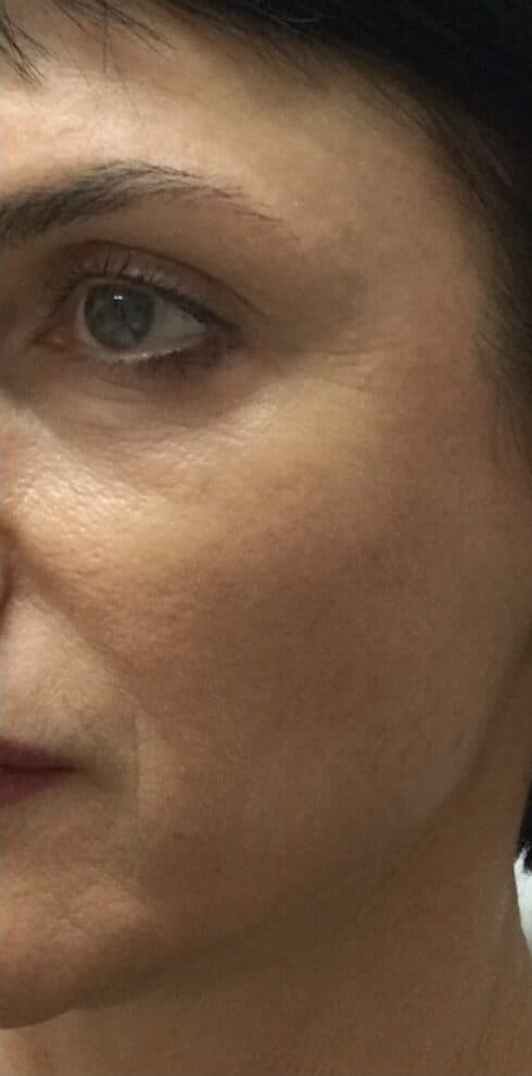 cheek filler before