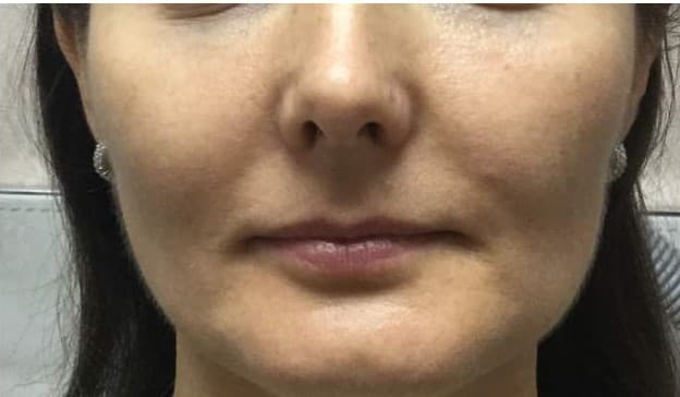 cheek filler after