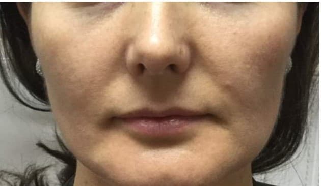 cheek filler before