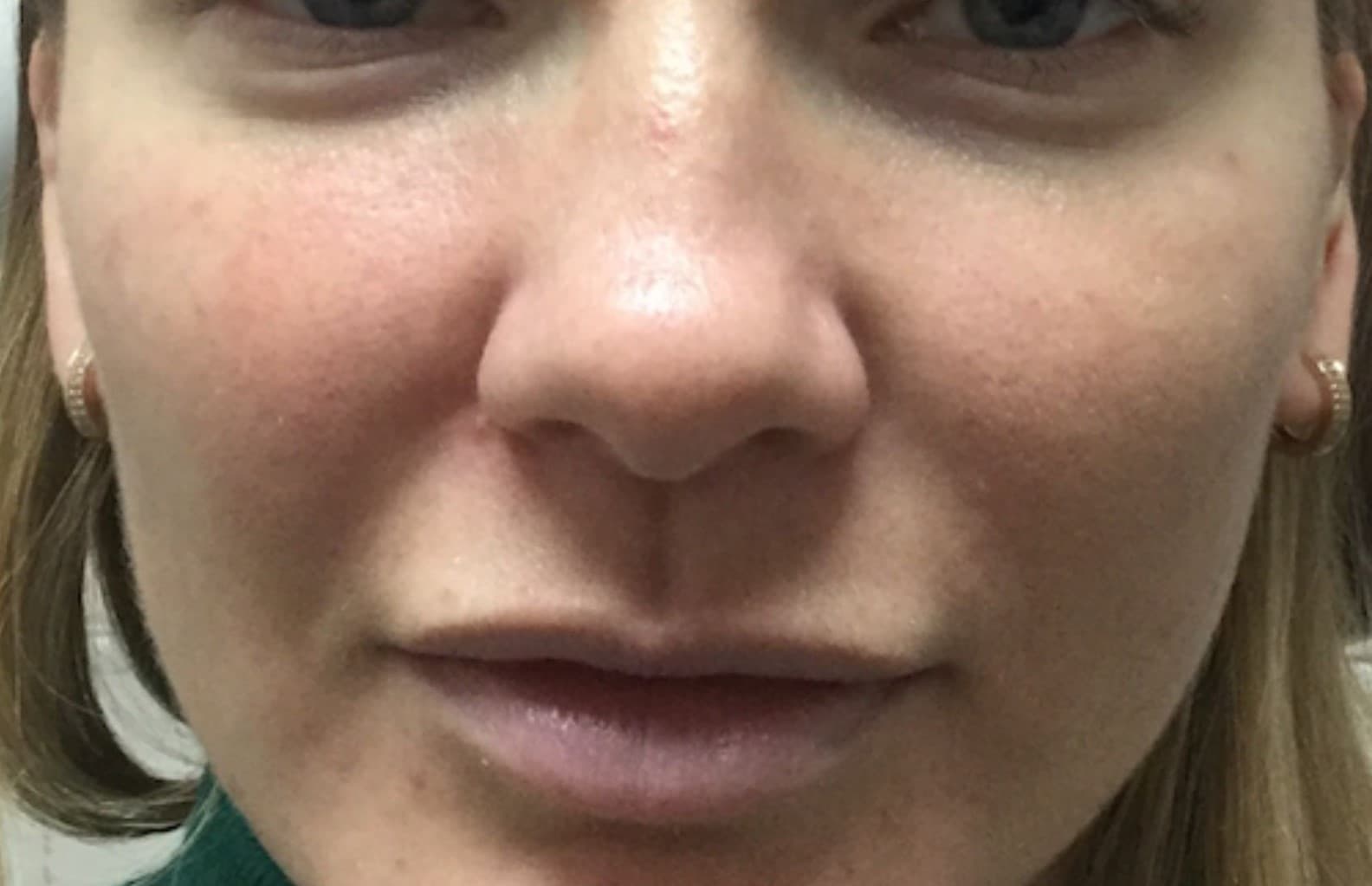 cheek filler after
