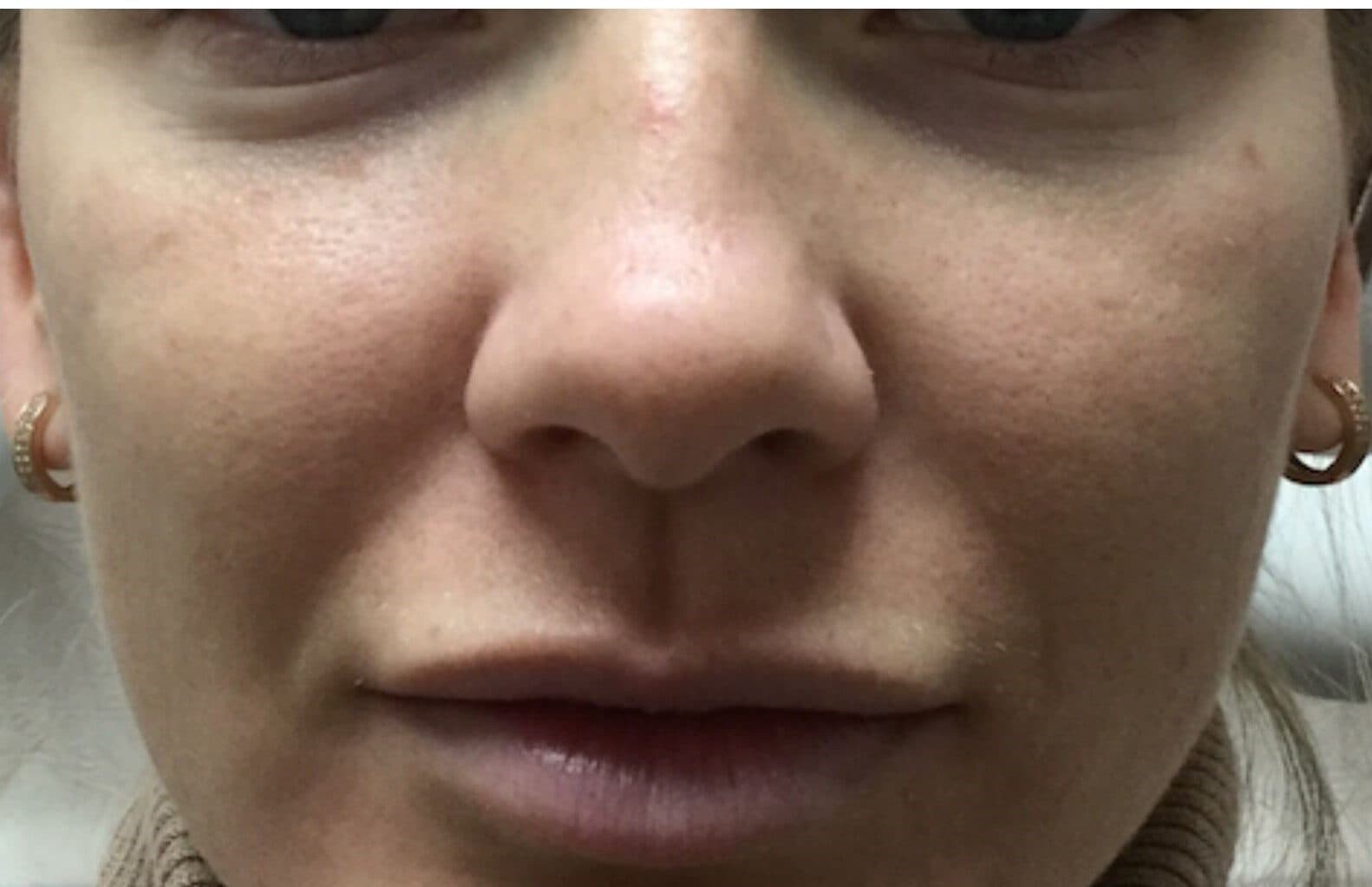 cheek filler before