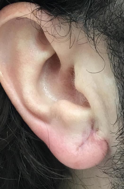 earlobe repair after