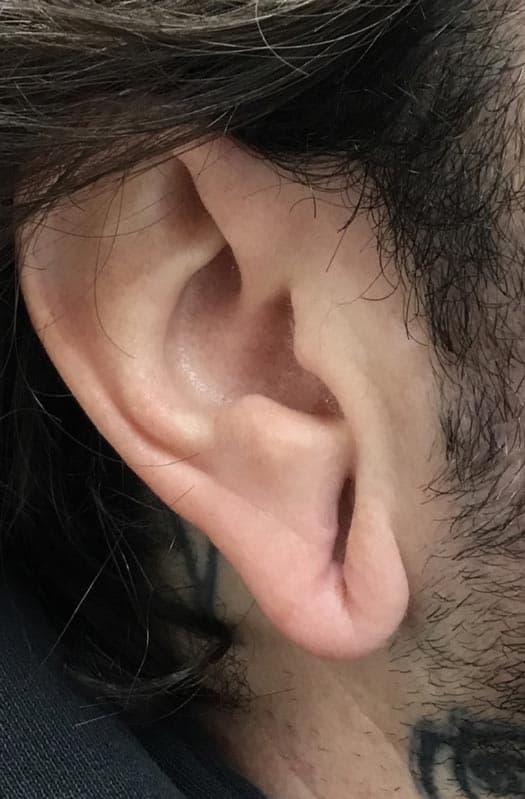 earlobe repair before