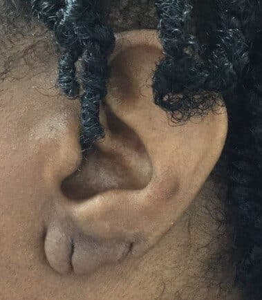 torn earlobe repair before