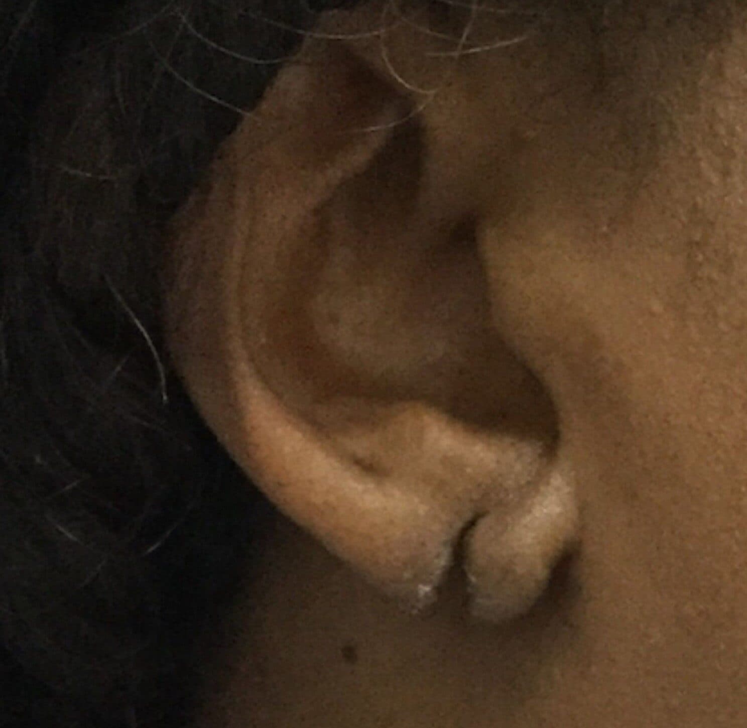 torn earlobe repair before