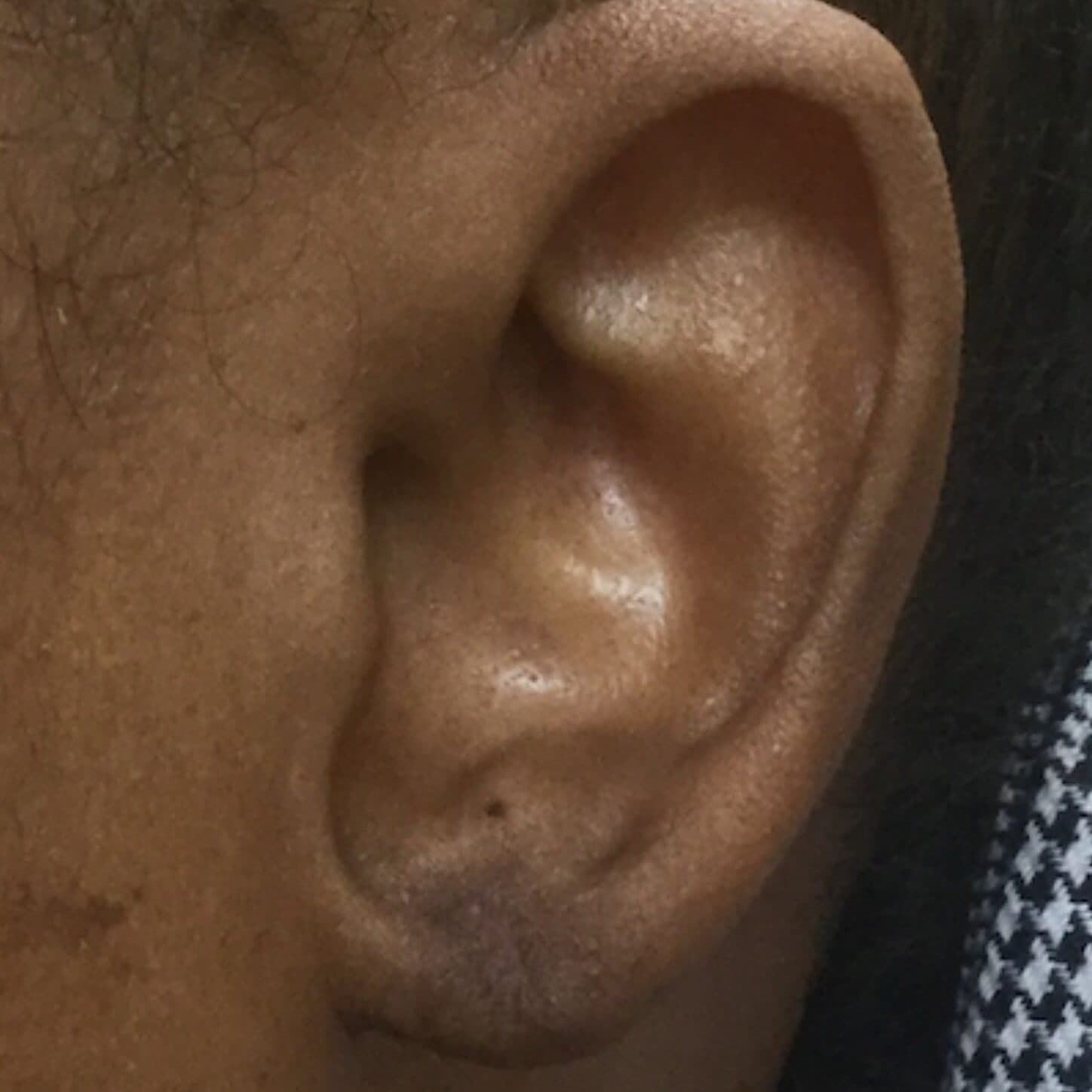 torn earlobe repair after