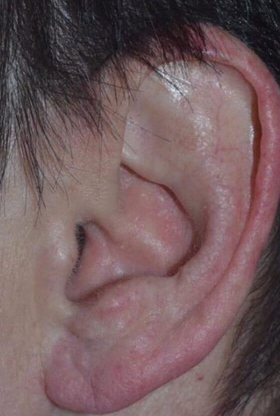 torn earlobe repair after