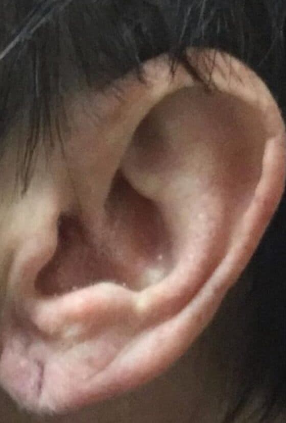 torn earlobe repair before