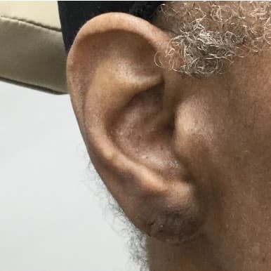torn earlobe repair after