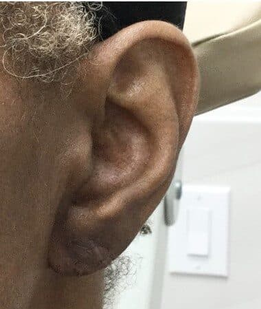 torn earlobe repair after