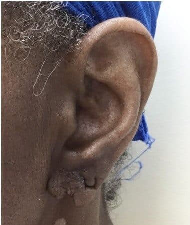 torn earlobe repair before
