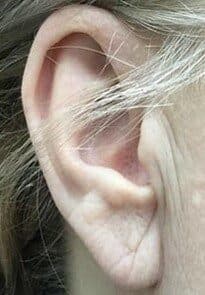 torn earlobe repair after