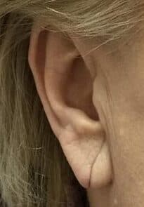 torn earlobe repair before