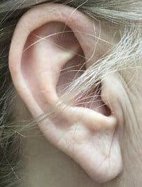 torn earlobe repair after