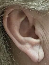 torn earlobe repair before