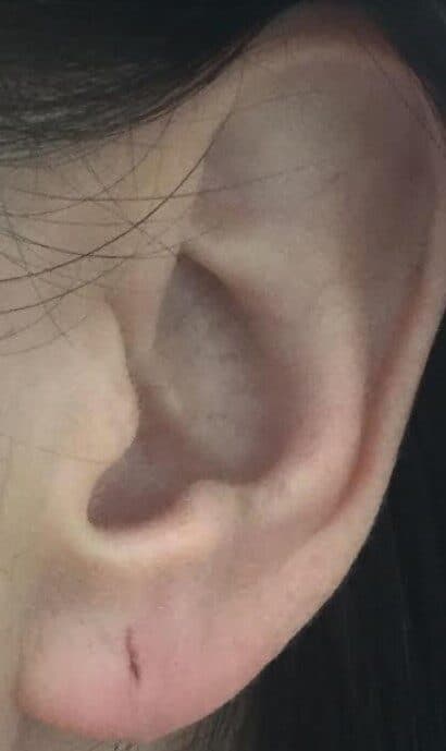 torn earlobe repair after