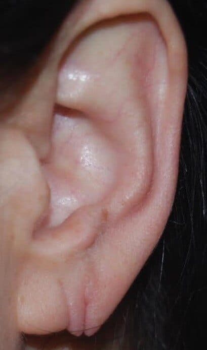 torn earlobe repair before